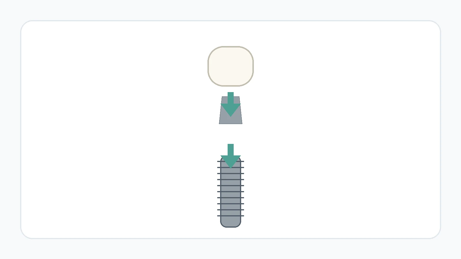 Exploded view showing a dental implant, abutment and crown as separate connected components.